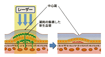 糖尿病網膜症について